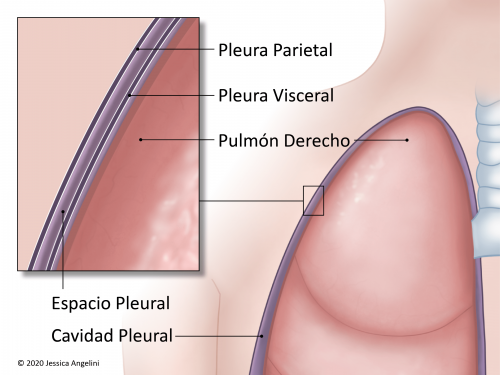 CatÃ©ter pleural permanente (PleurXâ¢) | OncoLink