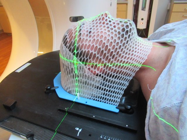 M scara Termopl stica De Radioterapia OncoLink